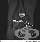 Артрография на коляно