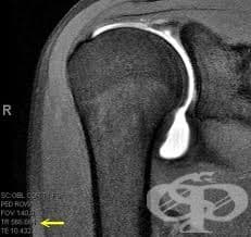 Артрография на рамо