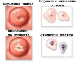 Биопсия на маточната шийка