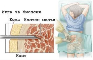 Костномозъчна аспирация и биопсия