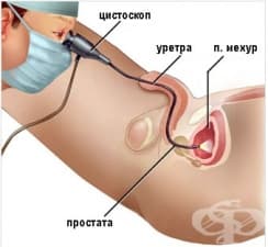 Цистоскопия