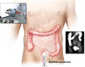 Рентгеново изследване на долния отдел на стомашно-чревния тракт