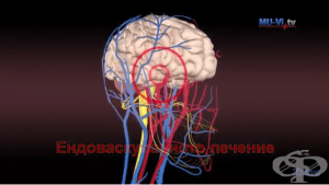 Ендоваскуларното лечение - шанс за качествен живот след инсулт