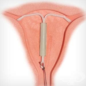    ()   (plastic IUD with progestogen) | ATC G02BA03 - 