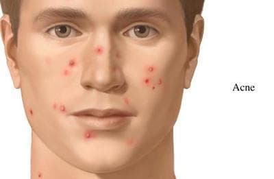 -     (ANTI-ACNE PREPARATIONS FOR SYSTEMIC USE) | ATC D10B - 