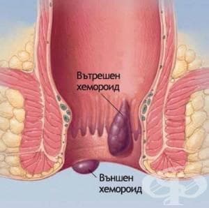 Хемороидите - болест на съвременното общество - изображение