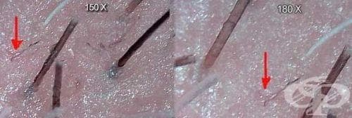 Поява в историята на медицината на синдрома на пълзящата кожа (Morgellons) - изображение