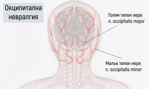 Окципитална невралгия - изображение
