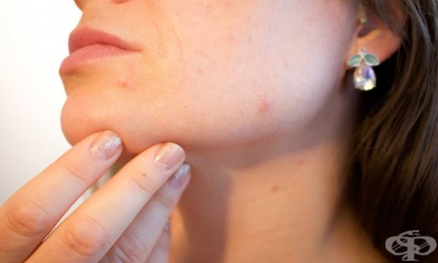Маскне: Акне, причинено от носенето на предпазна маска - изображение