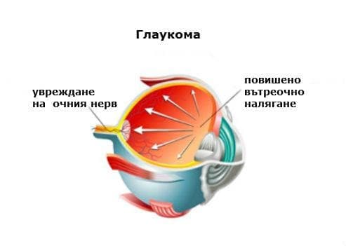 Вродена глаукома МКБ Q15.0 - изображение