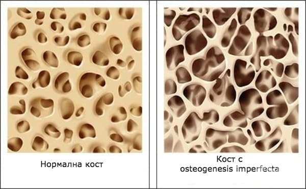 Други остеохондродисплазии МКБ Q78 - изображение