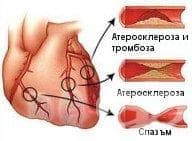 Остър инфаркт на миокарда МКБ I21 - изображение