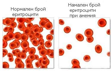 Анемия, свързана с храненето, неуточнена МКБ D53.9 - изображение