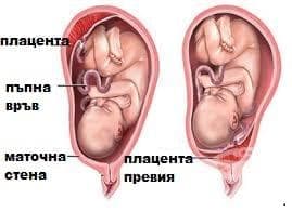   (placenta previa)  O44 - 