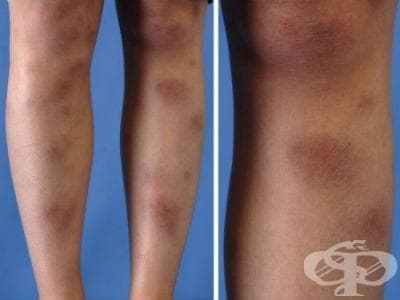 Erythema nodosum МКБ L52 - изображение