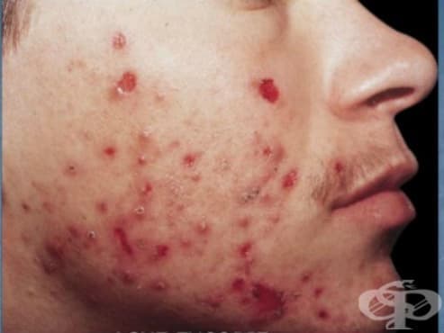 Acne excoriee des jeunes filles МКБ L70.5 - изображение