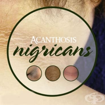 Acanthosis nigricans МКБ L83 - изображение