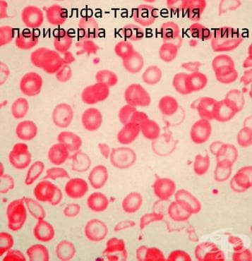 Алфа таласемия МКБ D56.0 - изображение