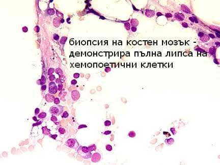 Апластична анемия, неуточнена МКБ D61.9 - изображение
