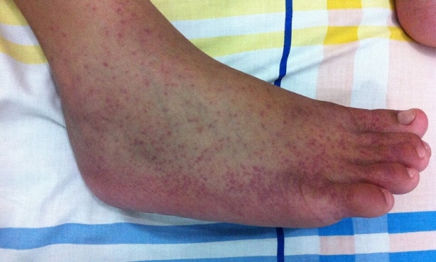 ,   Chikungunya-  A92.0 - 
