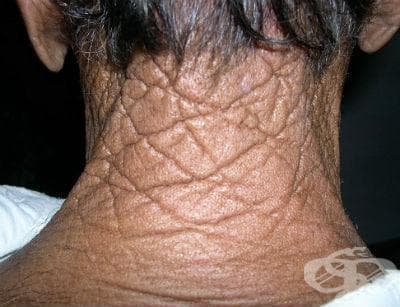 Cutis rhomboidalis nuchae МКБ L57.2 - изображение