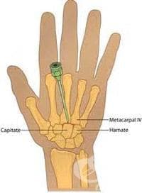 durere la prima articulație metacarpială a mâinii