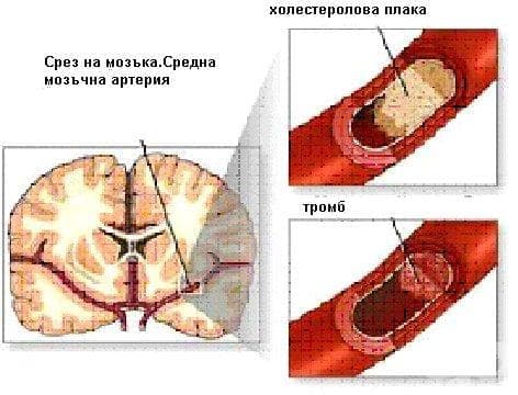 Мозъчносъдови болести МКБ I60-I69 - изображение