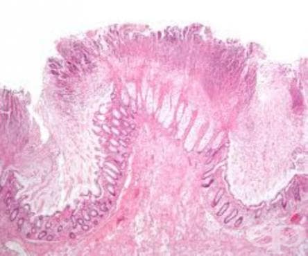 Ентероколит, предизвикан от Clostridium difficile МКБ A04.7 - изображение