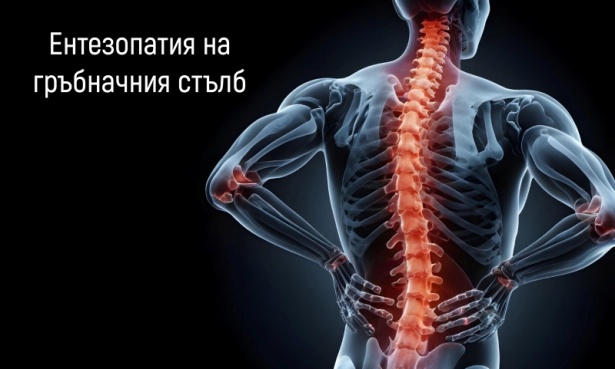 Ентезопатия на гръбначния стълб МКБ M46.0 - изображение