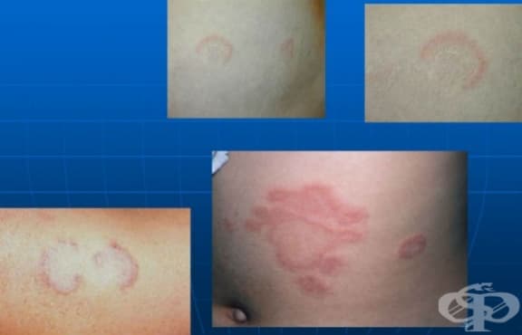 Erythema annulare centrifugum МКБ L53.1 - изображение