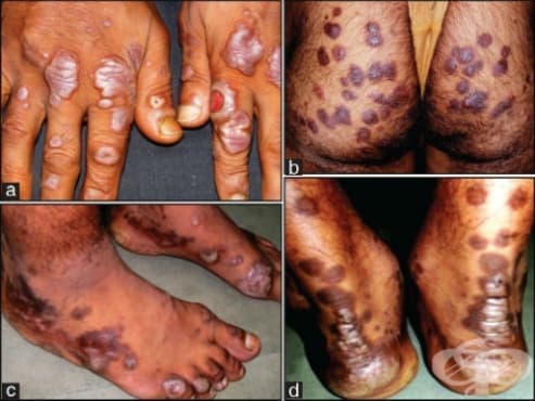 Erythema elevatum diutinum МКБ L95.1 - изображение