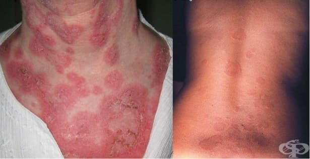 Erythema marginatum МКБ L53.2 - изображение