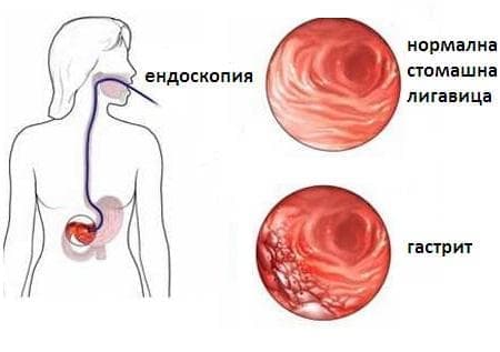 Гастрит, неуточнен МКБ K29.7 - изображение