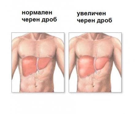 Хепатомегалия, некласифицирана другаде МКБ R16.0 - изображение