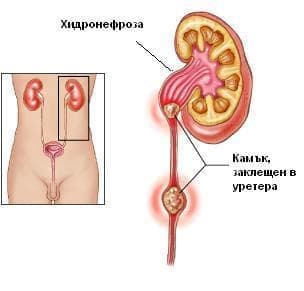 Хидронефроза с обструкция на бъбрек и уретер, причинена от камъни МКБ N13.2 - изображение