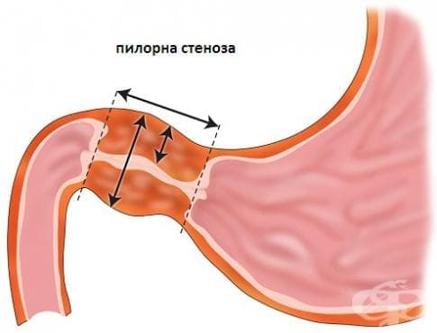 Хипертрофична пилорна стеноза у възрастни МКБ K31.1 - изображение
