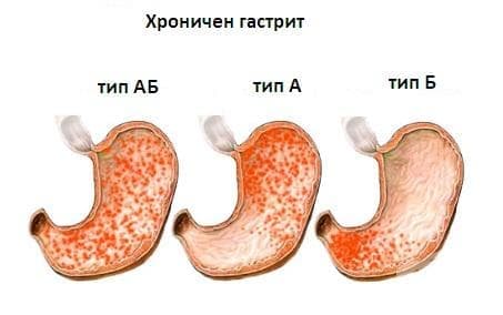 Хроничен гастрит, неуточнен МКБ K29.5 - изображение