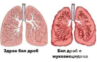 Кистозна фиброза с белодробни прояви МКБ E84.0 - изображение