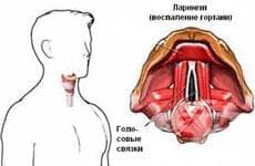 Остър ларингит и трахеит МКБ J04 - изображение