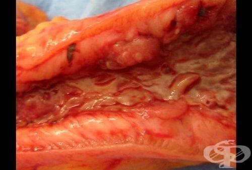 Болест на Crohn на дебелото черво МКБ K50.1 - изображение