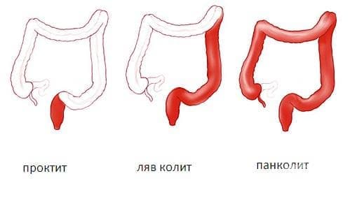 Мукозен проктоколит МКБ K51.5 - изображение