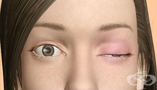 Myasthenia gravis МКБ G70.0 - изображение