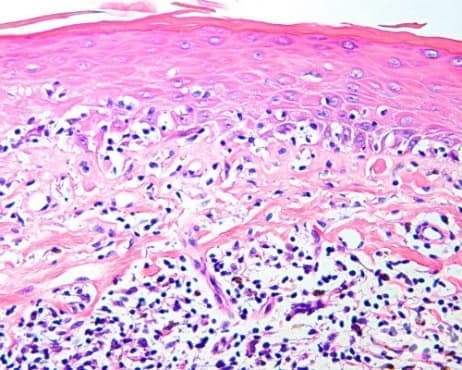 Mycosis fungoides  C84.0 - 