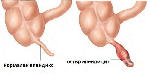 Остър апендицит МКБ K35 - изображение