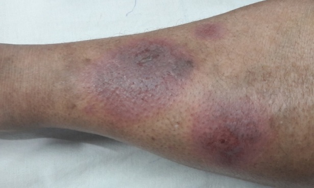 Неуточнен паникулит МКБ M79.3 - изображение