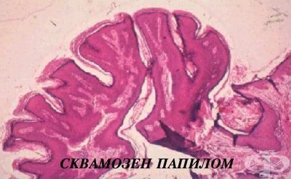 Други части на орофаринкса МКБ D10.5 - изображение