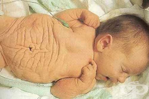 Prune belly syndrome (синдром с корем като сушена слива) МКБ Q79.4 - изображение