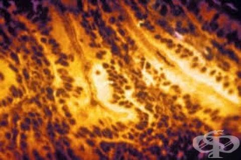 Шигелоза, предизвикана от Shigella boydii МКБ A03.2 - изображение