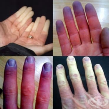 Синдром на Raynaud МКБ I73.0 - изображение