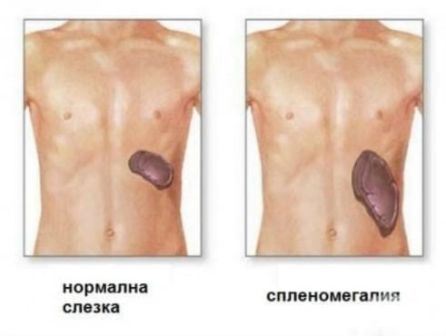 Спленомегалия, некласифицирана другаде МКБ R16.1 - изображение